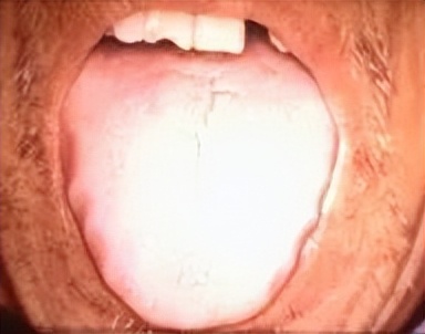 好多人说自己湿气重,怎么感觉自己湿气多