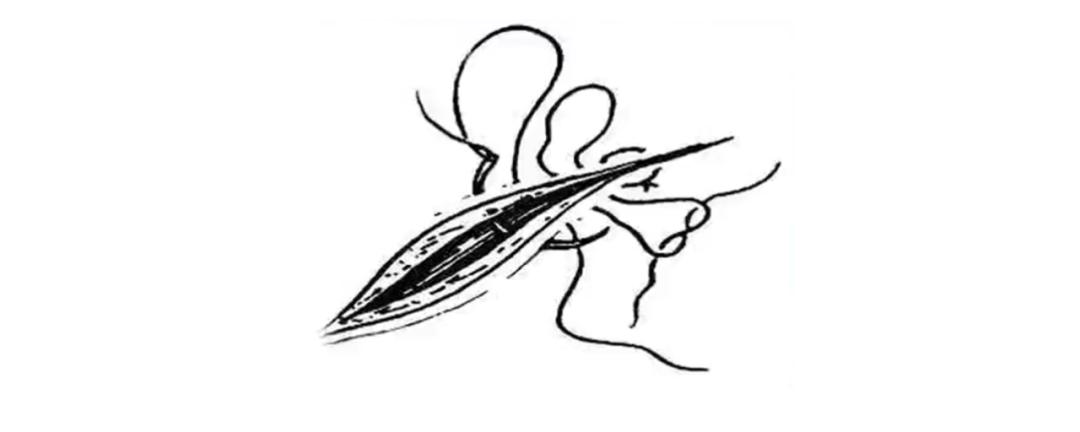 外科各种缝合方法的适用情况,外科操作缝合