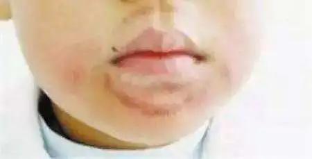 小孩张嘴睡觉腺样体肥大图片,孩子睡觉张嘴呼吸腺样体肥大图片