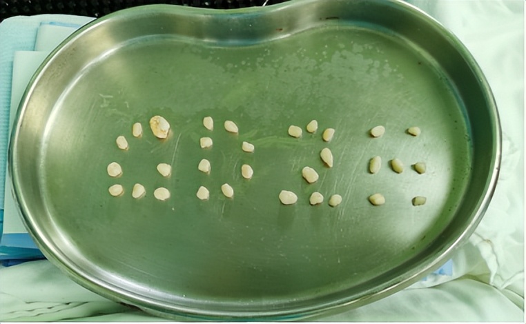 脚踝扭伤的处理方法和注意事项,轻度脚踝扭伤的处理方法及康复