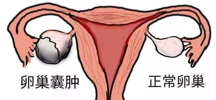 什么是卵巢囊肿？导致卵巢囊肿的原因有哪些？如何预防卵巢囊肿？