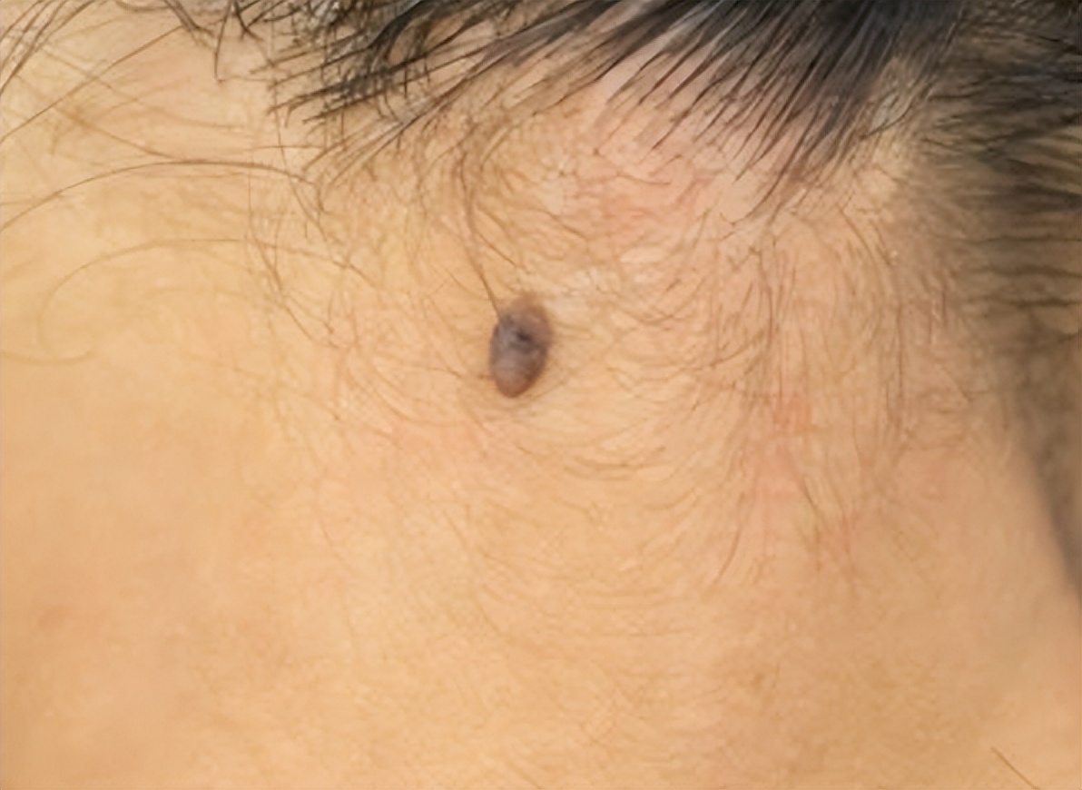 身上这3个地方长痣癌症可能来了,身上三个地方出现痣说明是癌变