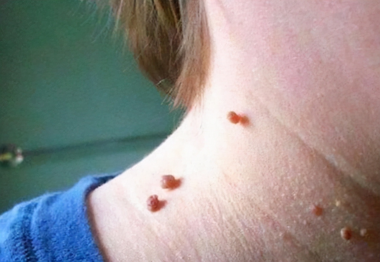 脖子上长小肉粒有什么办法治疗吗,脖子上长小肉粒会治愈么