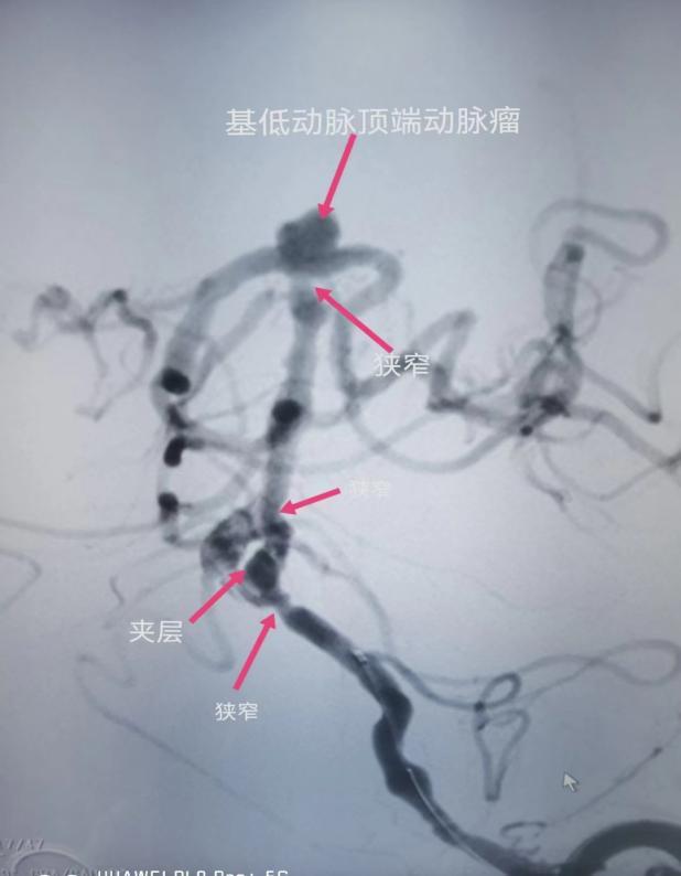 沣东院区脑病病区成功完成多例脑血管造影及颅内支架植入术