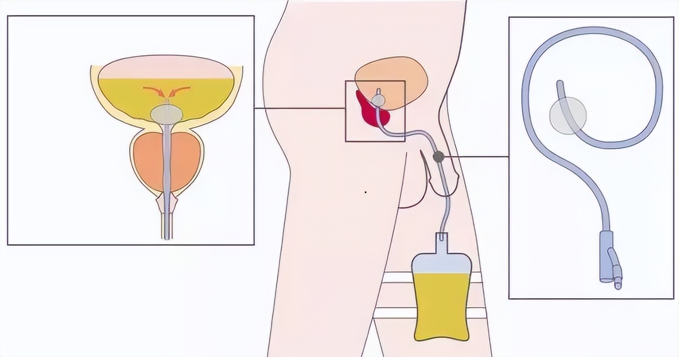 为什么尿管不能自己拔,如何拔除尿管