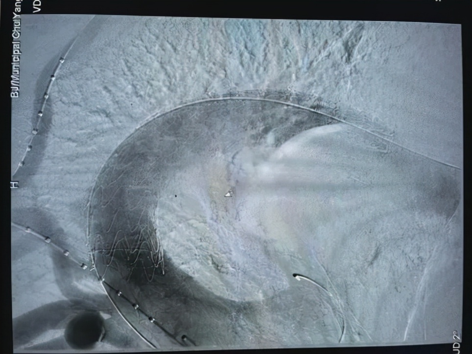 大脑中动脉动脉瘤介入栓塞手术,大脑前动脉夹层手术