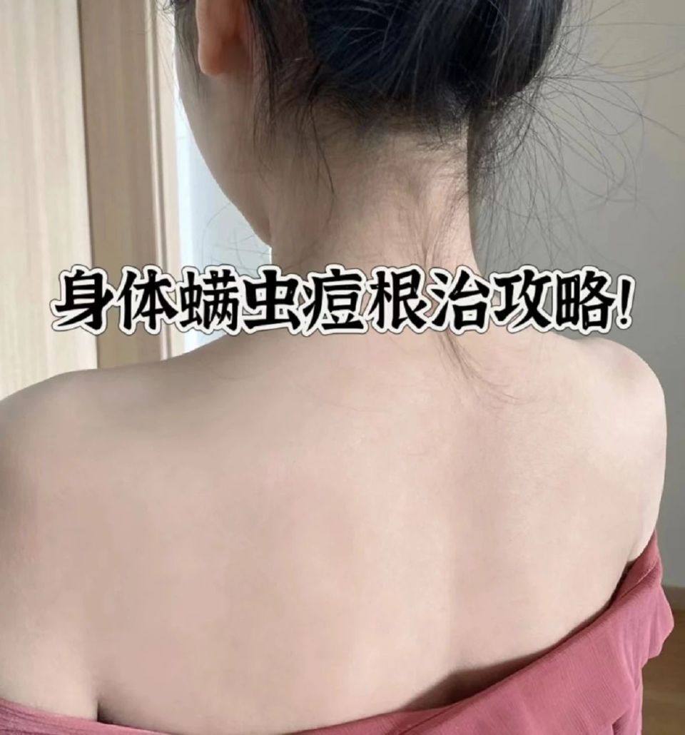 满背的痘痘用什么药,痘痘反反复复如何祛痘