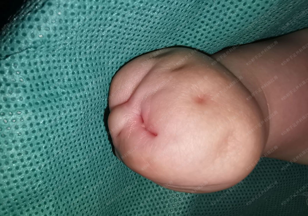 并指切开以后会长好吗,并指可以切开吗