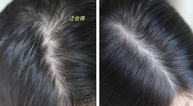 孕妇控油止痒去屑洗发水推荐,控油好的孕妇洗发水品牌