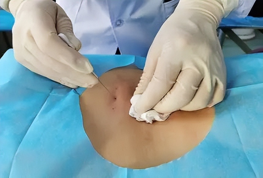 关于小针刀,你想知道的都在这