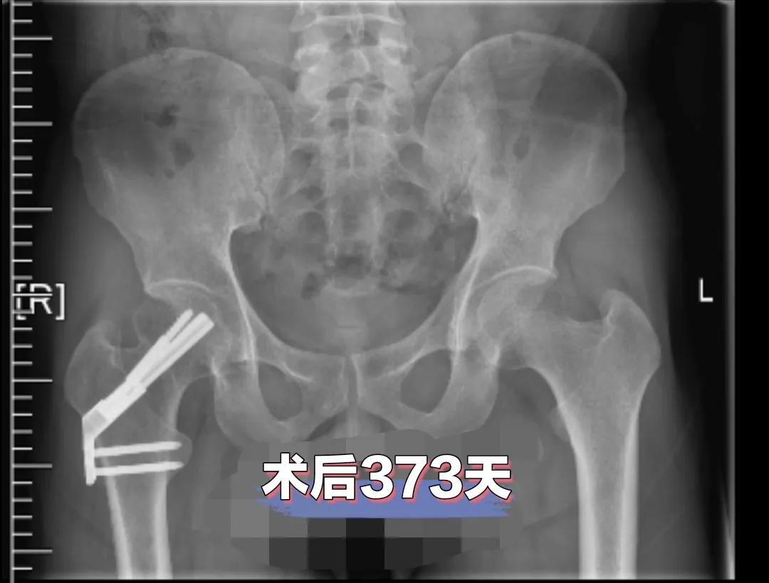 股骨颈骨折康复治疗,股骨颈骨折内固定康复