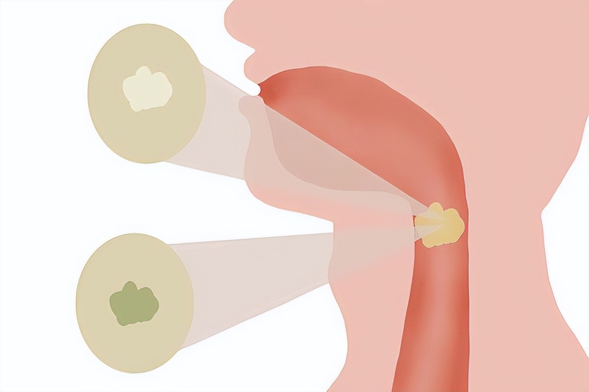 咳出黑痰黄痰白痰分别代表什么,痰是绿色的提示什么病