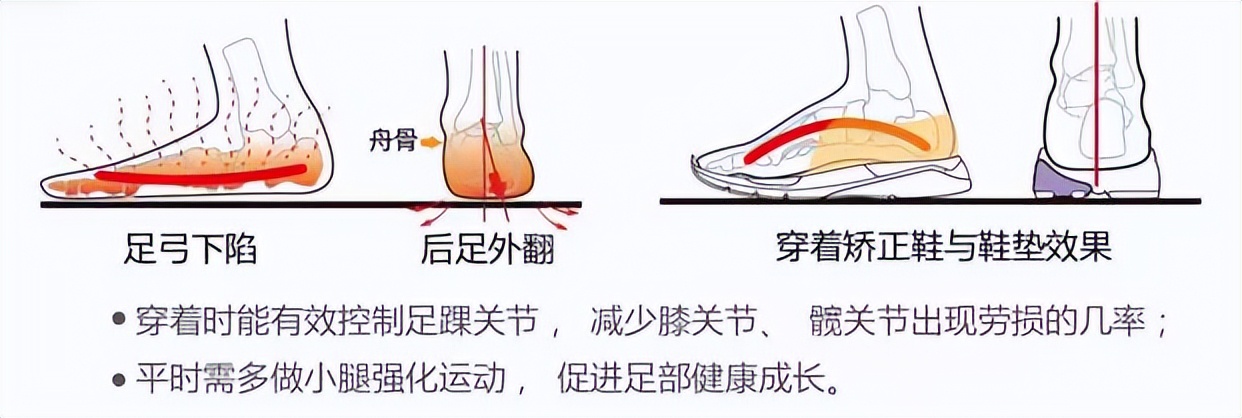 扁平足穿鞋子有什么讲究吗,扁平足要穿专用的鞋子吗