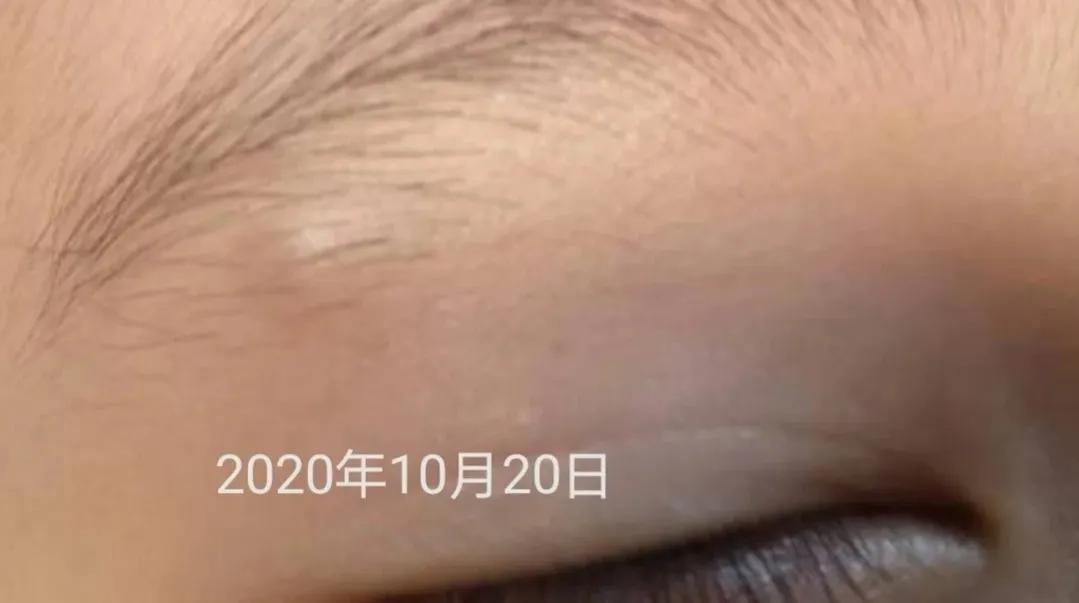 皮脂腺囊肿和粉刺瘤,火针治疗皮脂腺囊肿