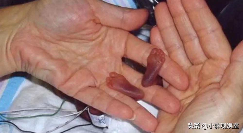 真的拇指姑娘现在怎么样了,现实版拇指姑娘如今怎样了