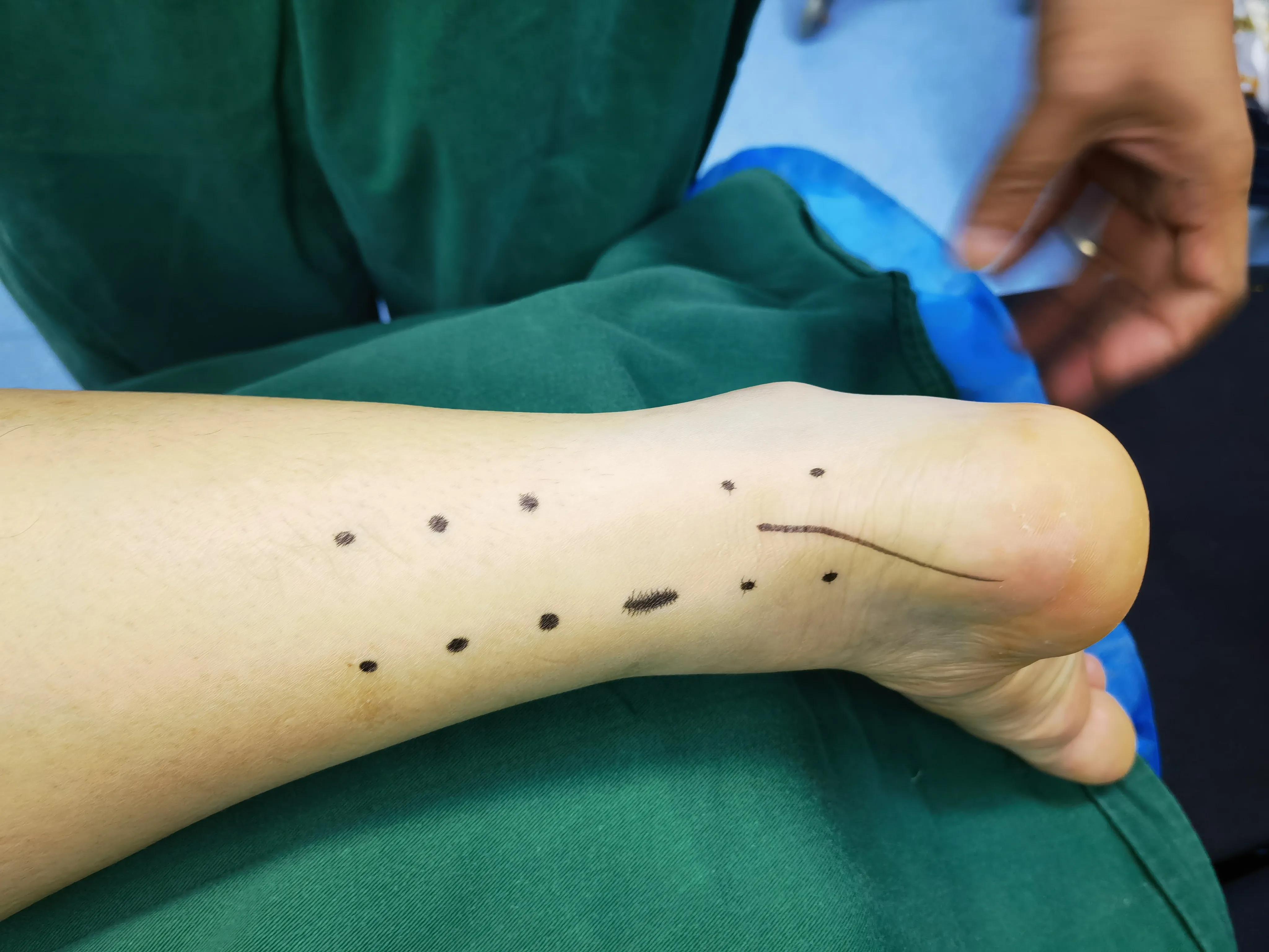 跟腱断裂术后疤痕增生怎么办,跟腱断裂术后跟腱如何愈合