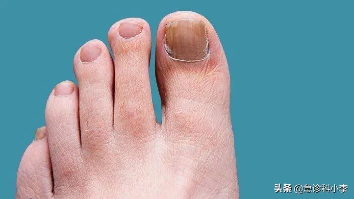 脚趾甲老往肉里长怎么办,甲沟炎脚趾甲往两旁长怎么办