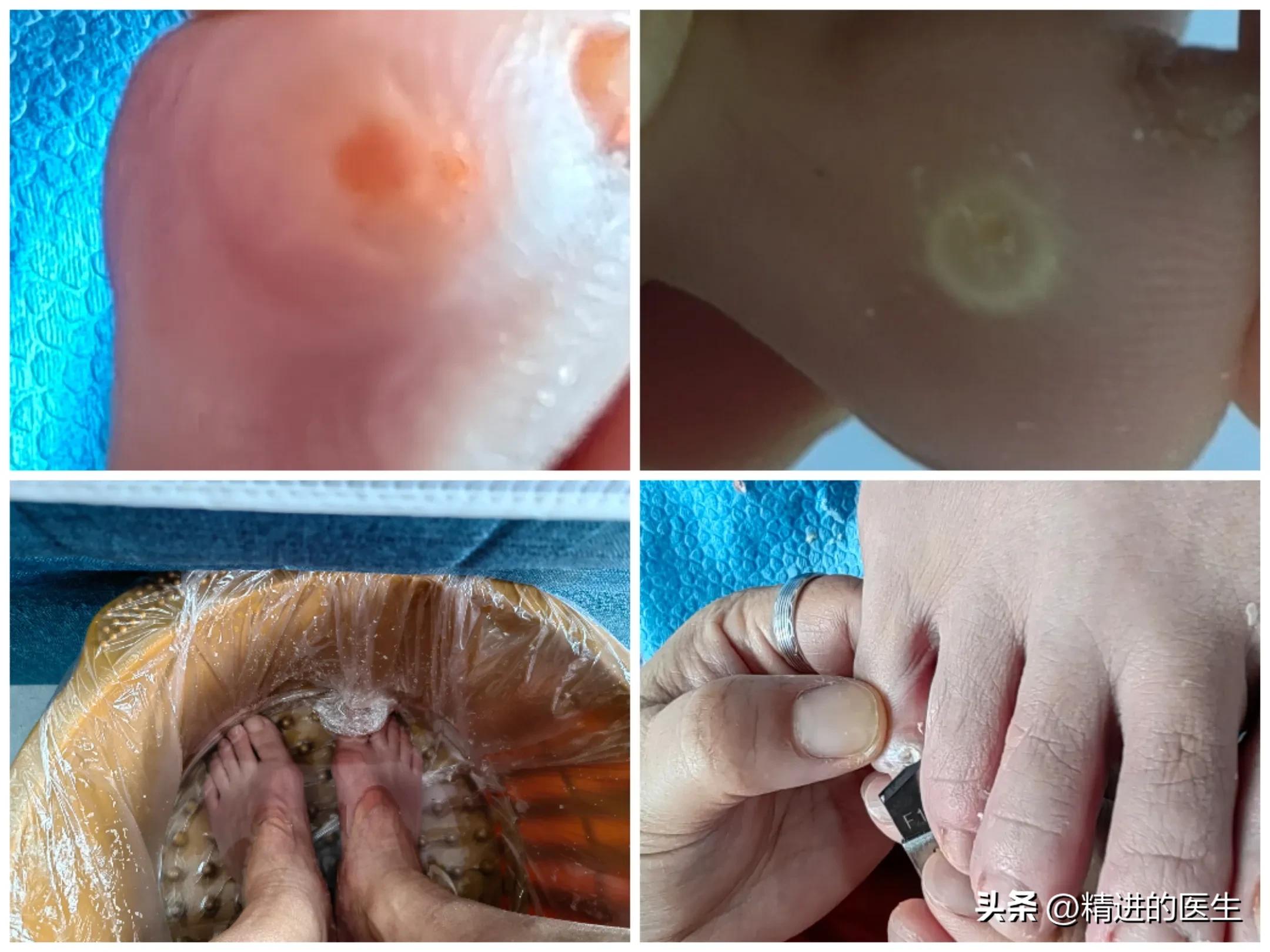 鸡眼连根拔起,鸡眼去除小妙招