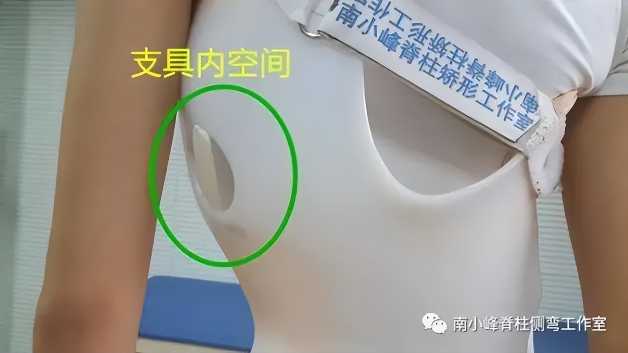 脊柱侧弯矫正支具不调整会怎样,简单辨别脊柱侧弯避免孩子走弯路