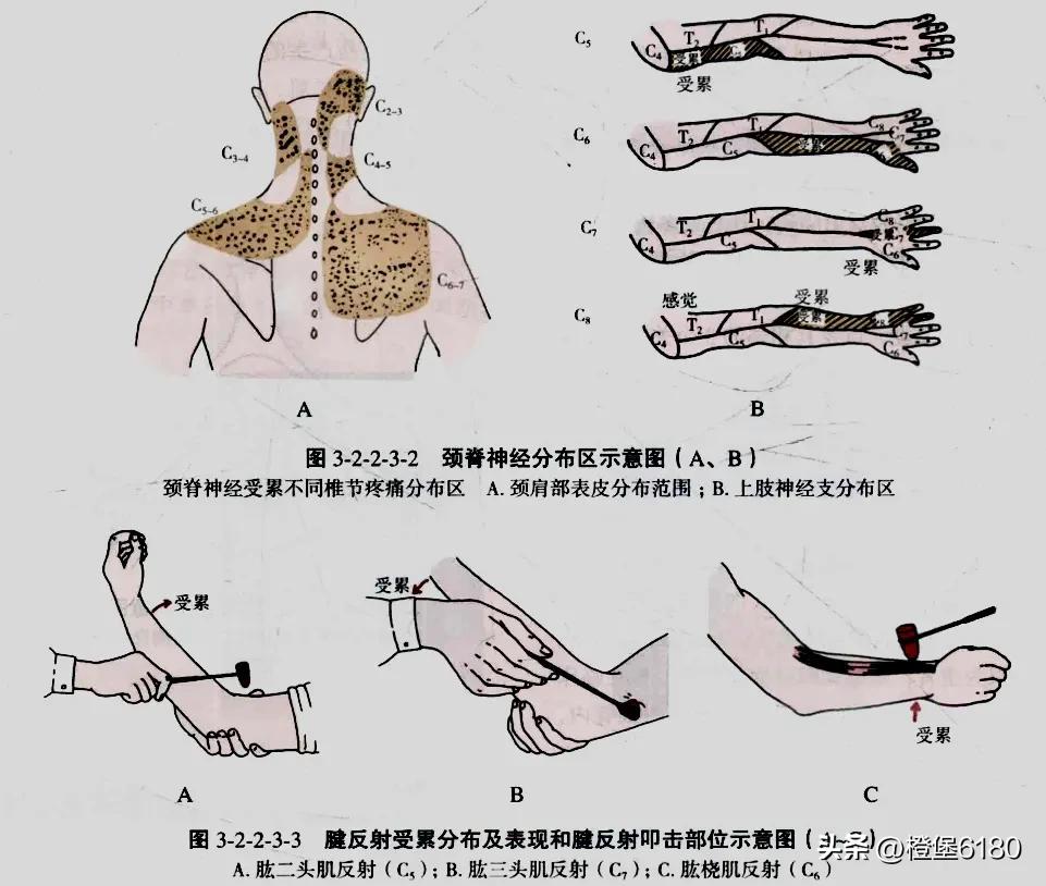 颈椎病导致的手臂酸软无力怎么办,神经根型颈椎病手臂酸胀麻怎么办