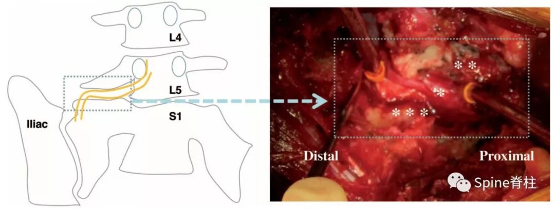 腰椎间盘突出下肢放射痛严重吗,下肢放射疼痛是间断性严重吗