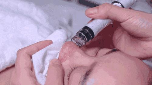 鼻头长黑粉刺怎么回事图片,鼻梁及两侧起了闭口粉刺