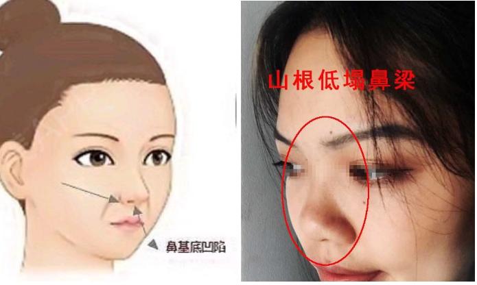 塌鼻子变美思路看这里,塌鼻梁怎么变漂亮