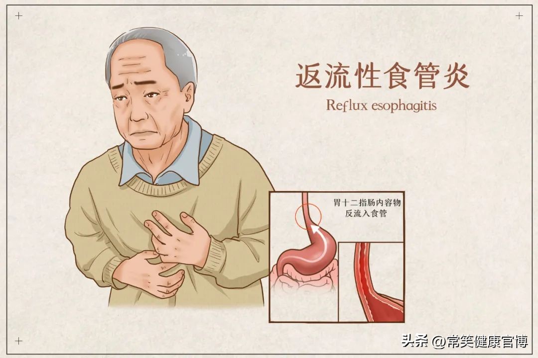 反流性食管炎反反复复怎么回事,反流性食管炎一直反复怎么办