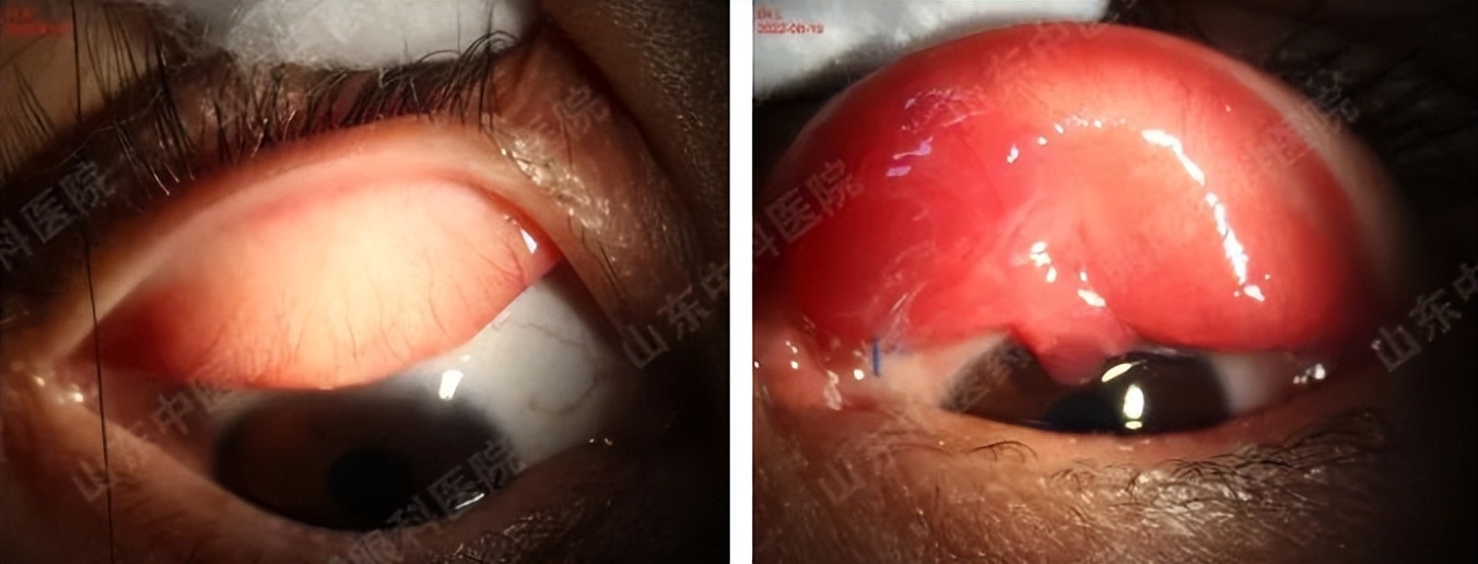 埋线双眼皮线头出来了严重吗,埋线双眼皮线头露在外边了怎么办