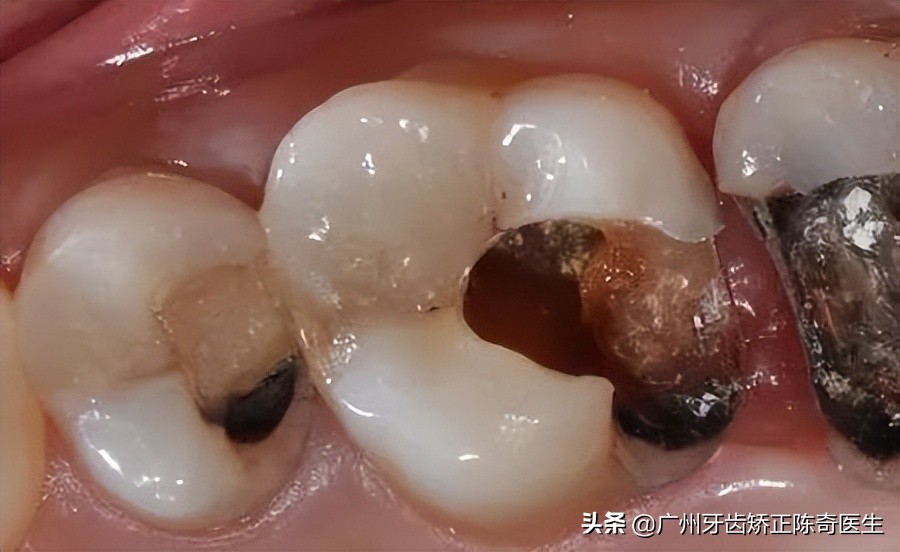 蛀牙在ct上如何看出来,拍ct发现蛀牙蛀成笑脸