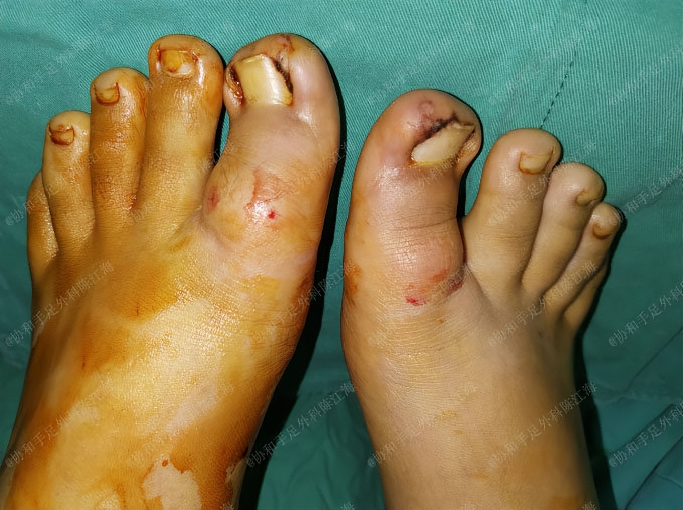 嵌甲炎拔甲还能长出来嘛,指甲根部嵌甲太深拔不出来怎么办