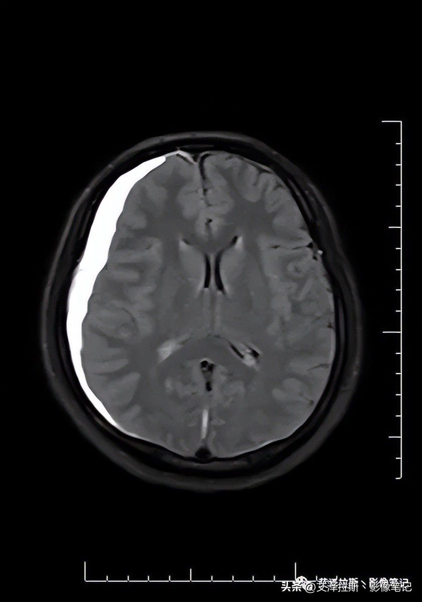中枢性低通气综合征,中枢性低通气综合征可以治愈吗