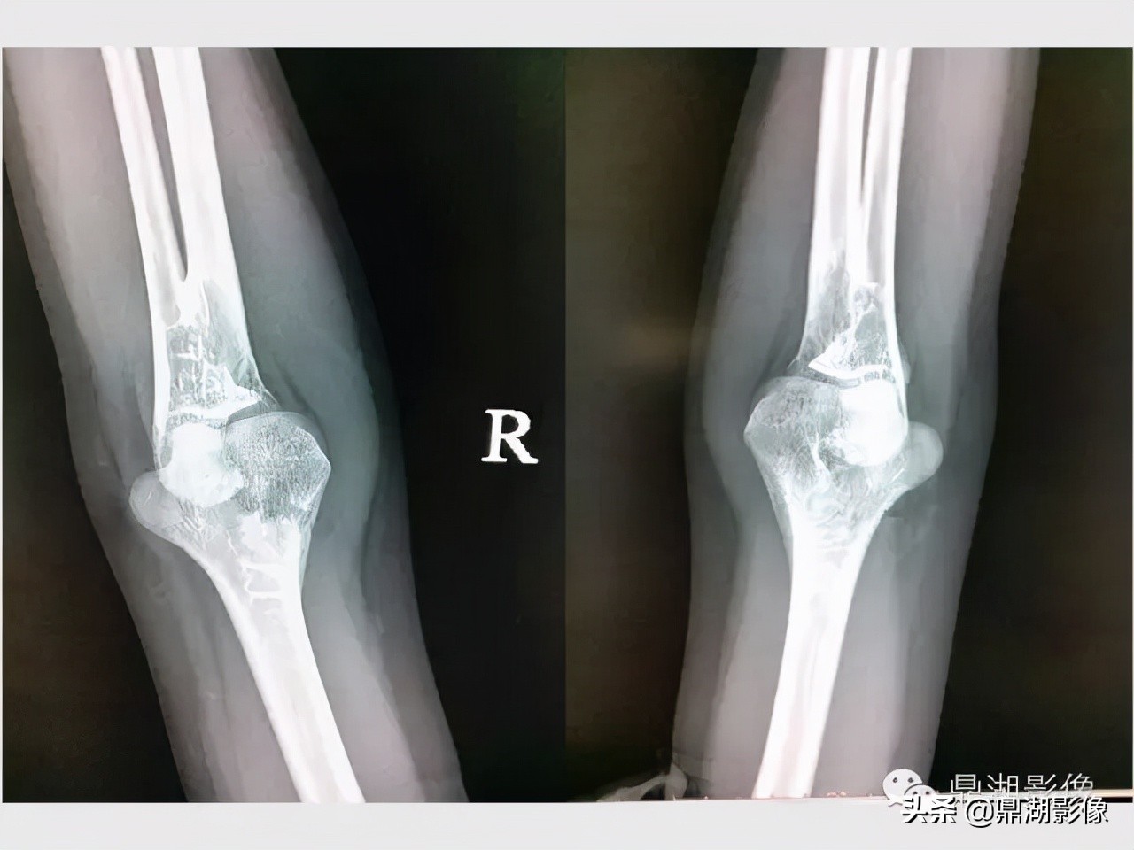 先天桡骨缺失畸形能治疗吗,先天性桡骨发育不良