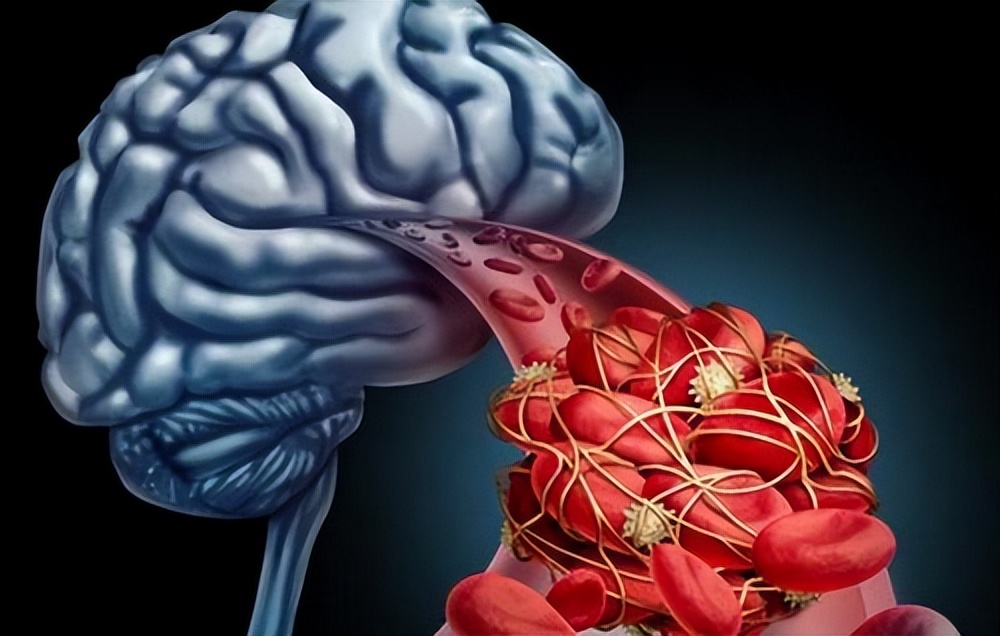 叶酸对防止中风有用吗,叶酸可以预防脑卒中吗