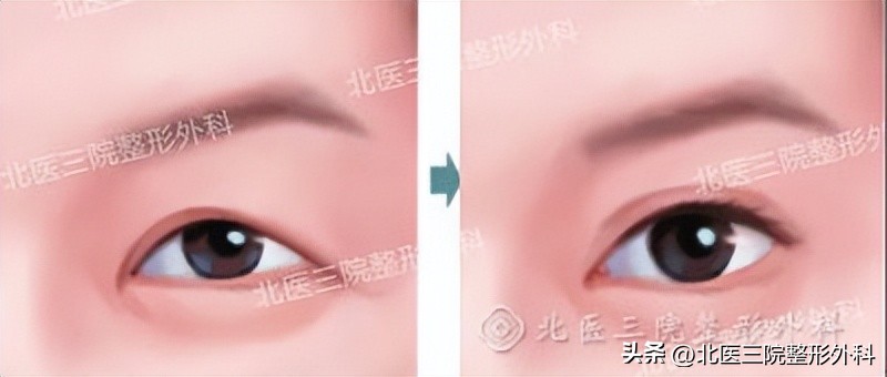 双眼皮皮肤松弛怎么办,双眼皮多年后眼皮松弛怎么办