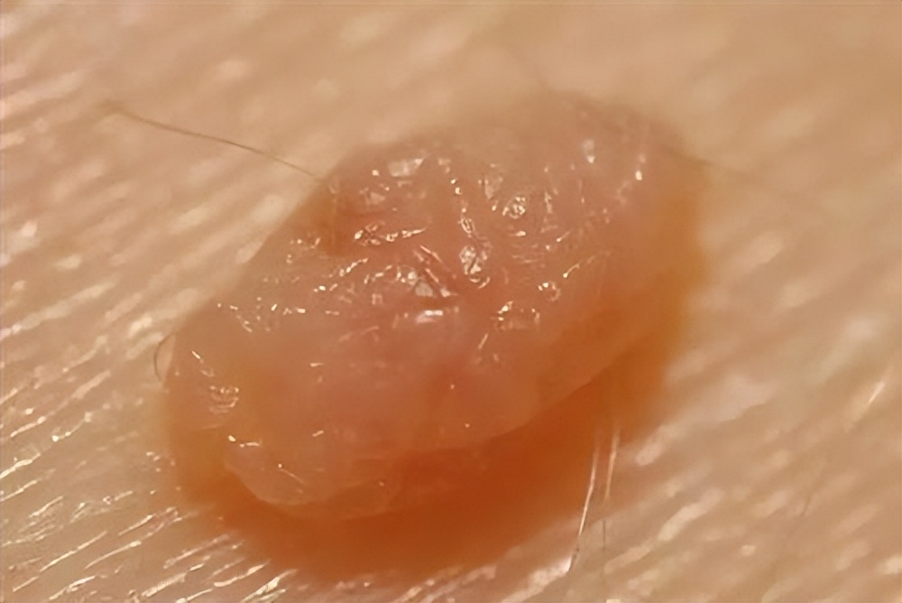 脖子和腋下的“小肉粒”是什么？能直接用手揪掉吗？医生揭露真相