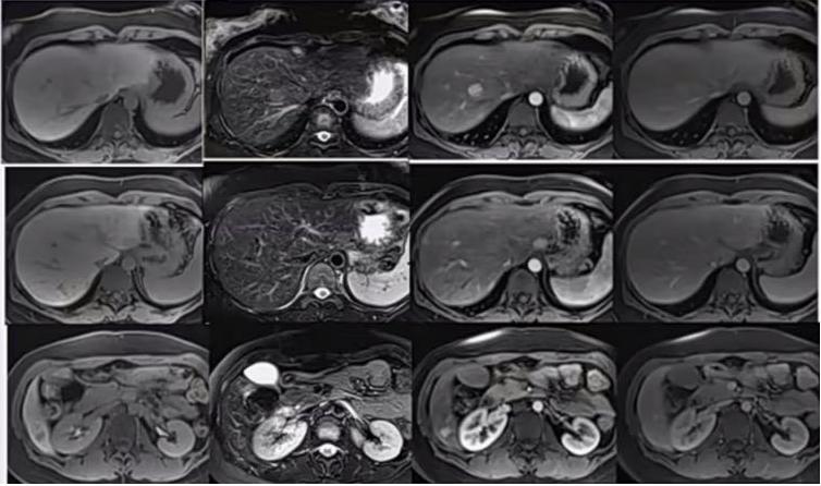 肝囊肿和肝占位影像学鉴别,杨永峰医生个人简历