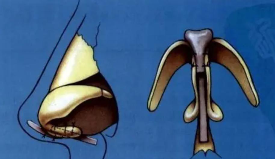 隆鼻以后鼻孔外露算是失败吗,露鼻孔的鼻子怎么隆鼻