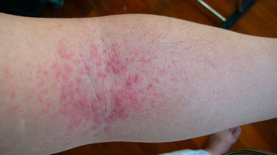 成人长痱子怎么办,长痱子怎么办丁香医生