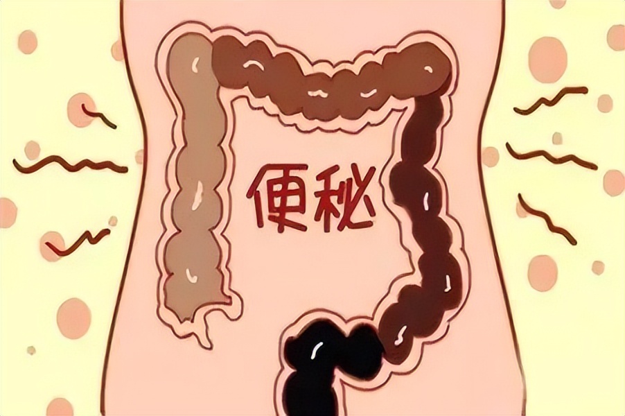 人体内有30斤宿便,人体有多少毒素从大便排出