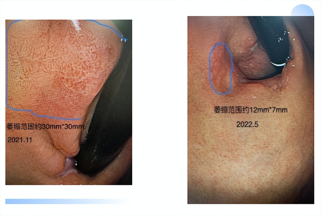 拒绝社死,去除病理口臭的方法