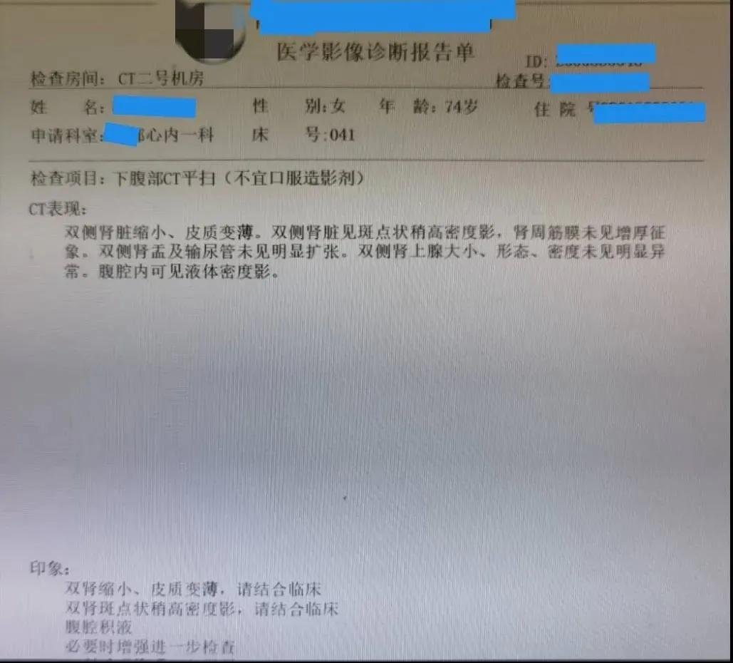 双下肢水肿心源性,心衰双下肢水肿
