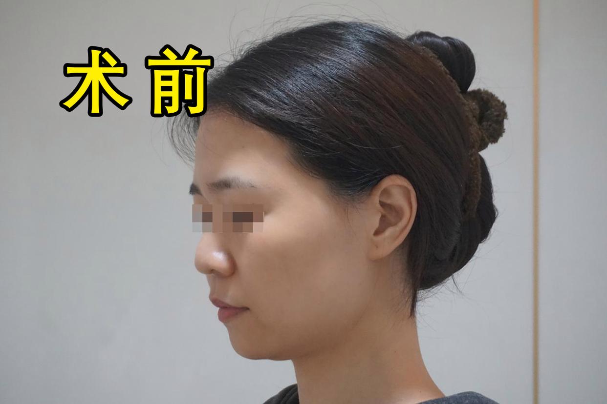 30岁女人做脸部美容,脸部面吸手术后的真实感受