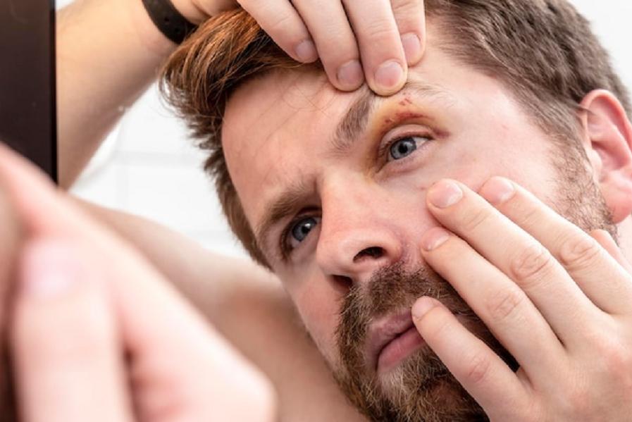 捡到眼镜蛇炖汤，剪掉的蛇头却突然“复活”，浙江老伯差点失明