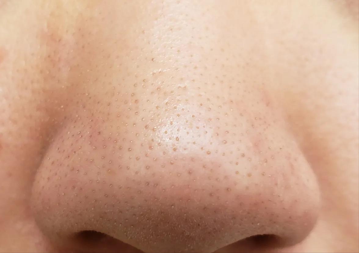 鼻子的黑头跟草莓一样,草莓黑头怎么去除最有效