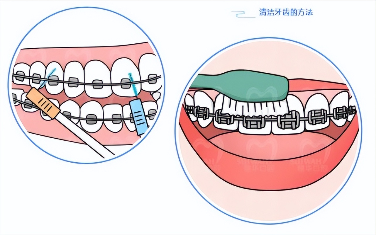 牙齿矫正拔牙和不拔牙有什么区别,牙齿矫正拔牙当天就可以矫正了吗