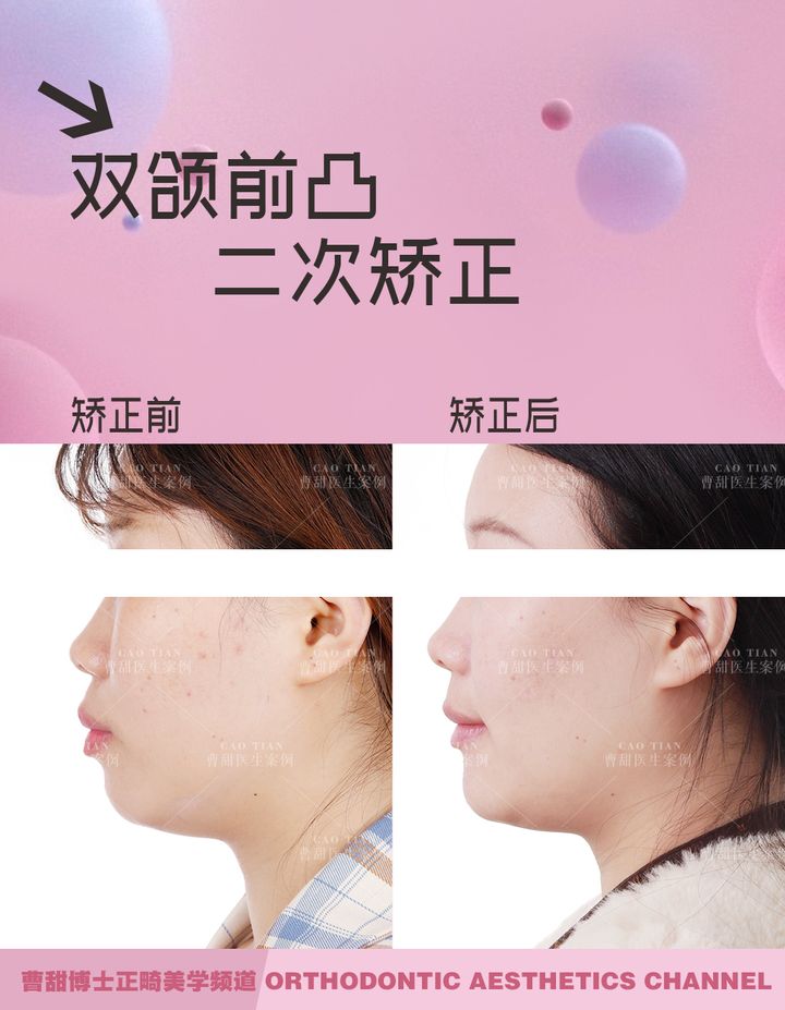 凸嘴下巴后缩拔牙改善有什么坏处,深覆合嘴凸下巴后缩矫正要拔牙吗