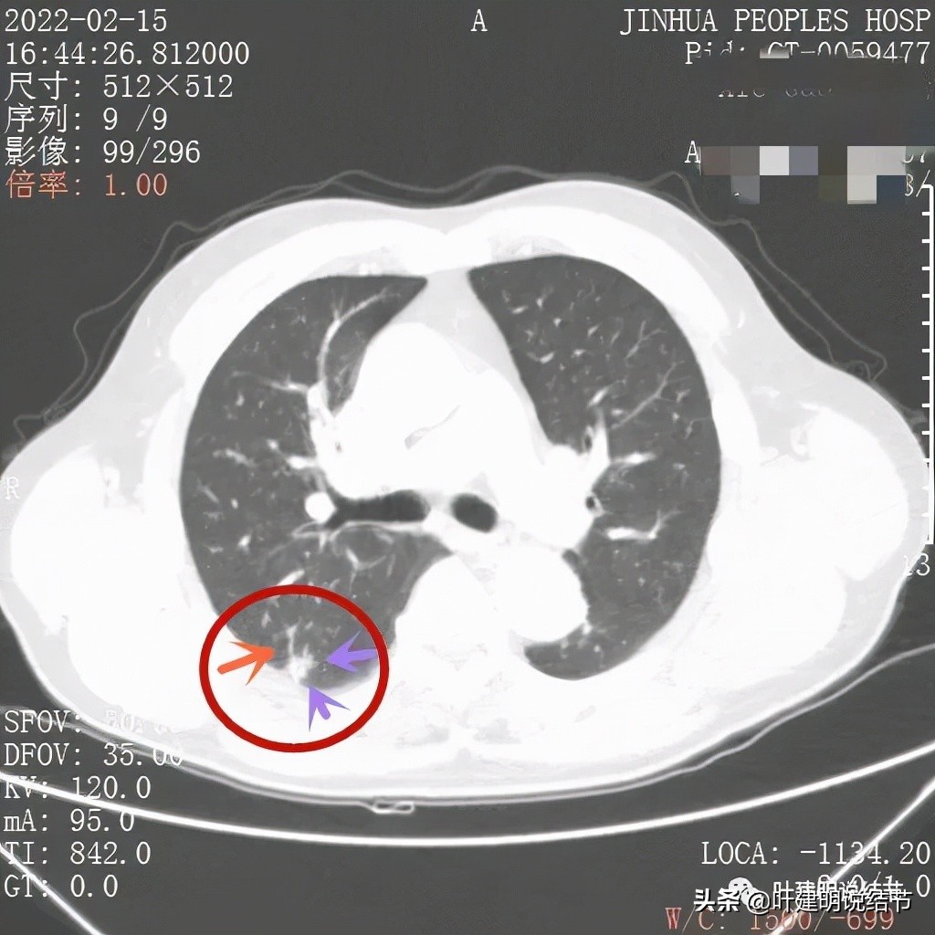 肺腺癌高危亚型什么意思,肺腺癌高危亚型
