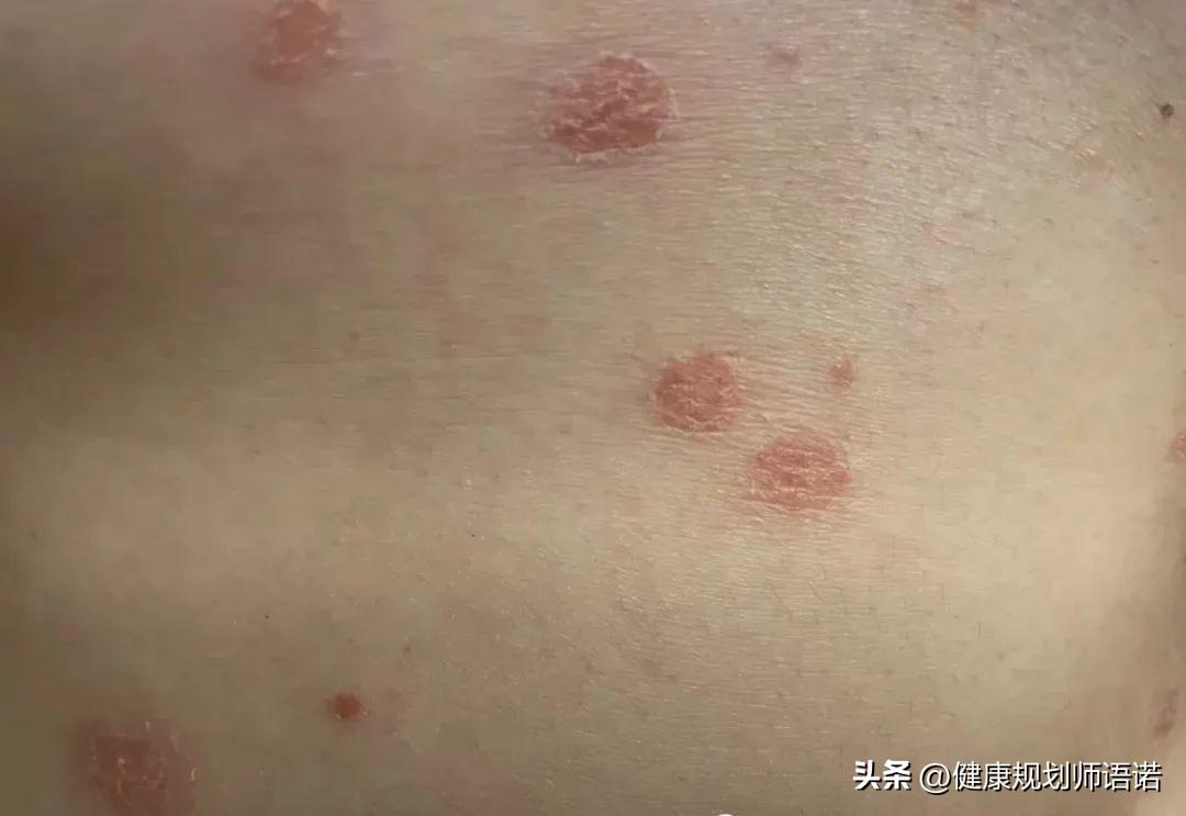 因宫颈问题走进阳光森林，用营养拯救了整个家族的健康