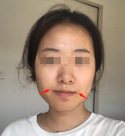 韦敏做下颌角怎么样,韦敏唇裂修复